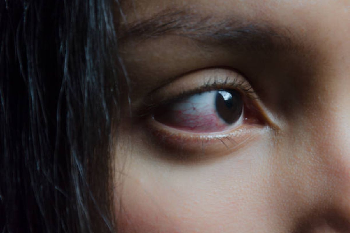 Why Are My Eyes Always Red When I Wake Up